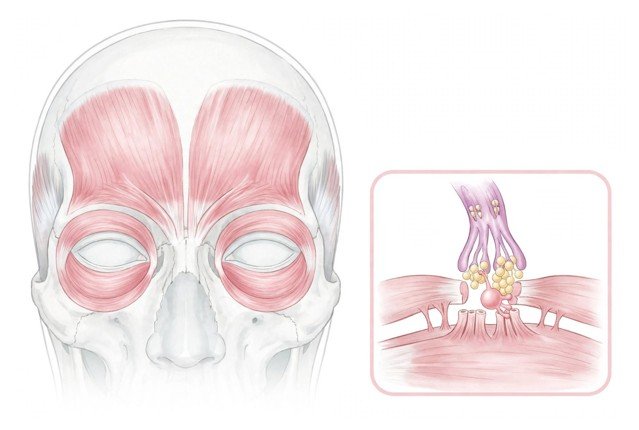 Understanding Dynamic Facial Lines and Neuromodulation